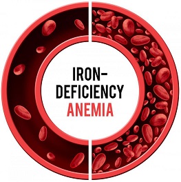 Green Tea Inhibit Iron Absorption